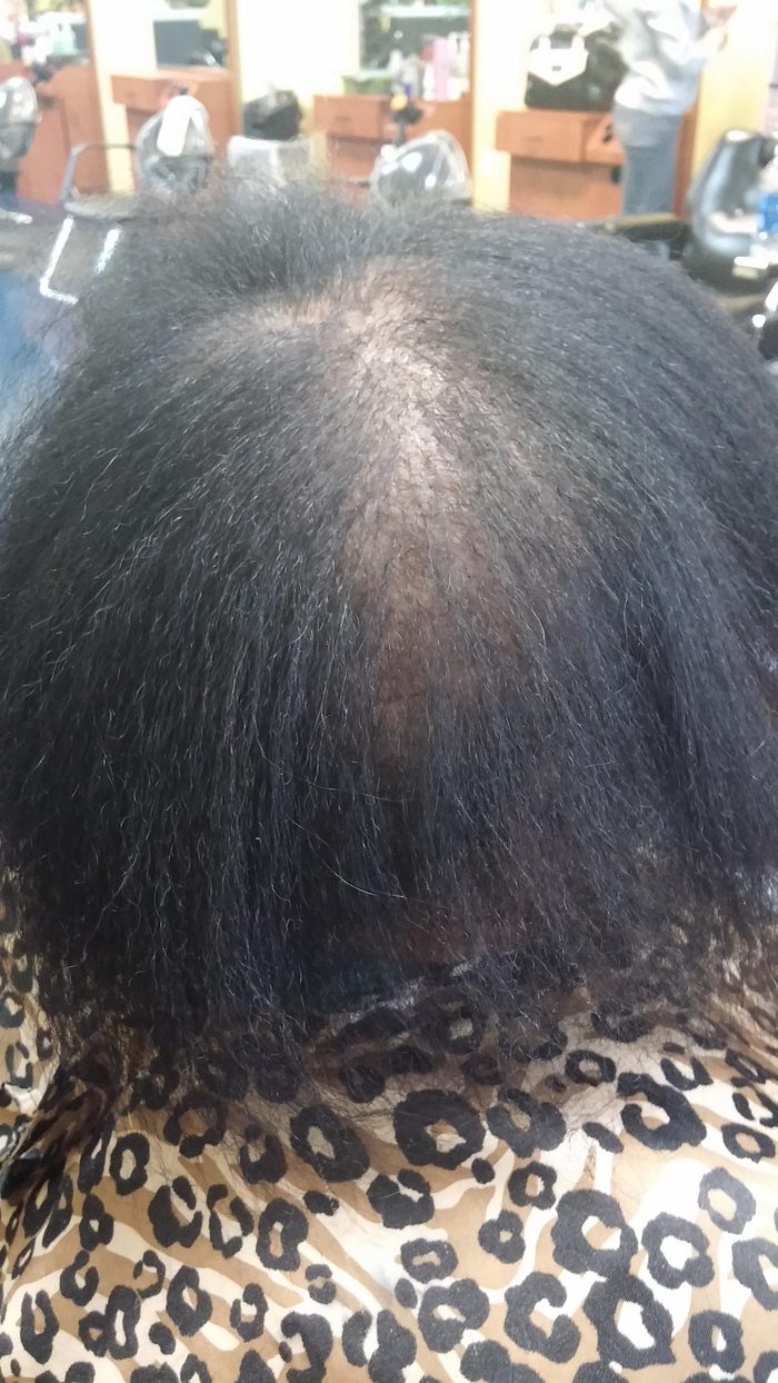 Client 2 before hair restoration