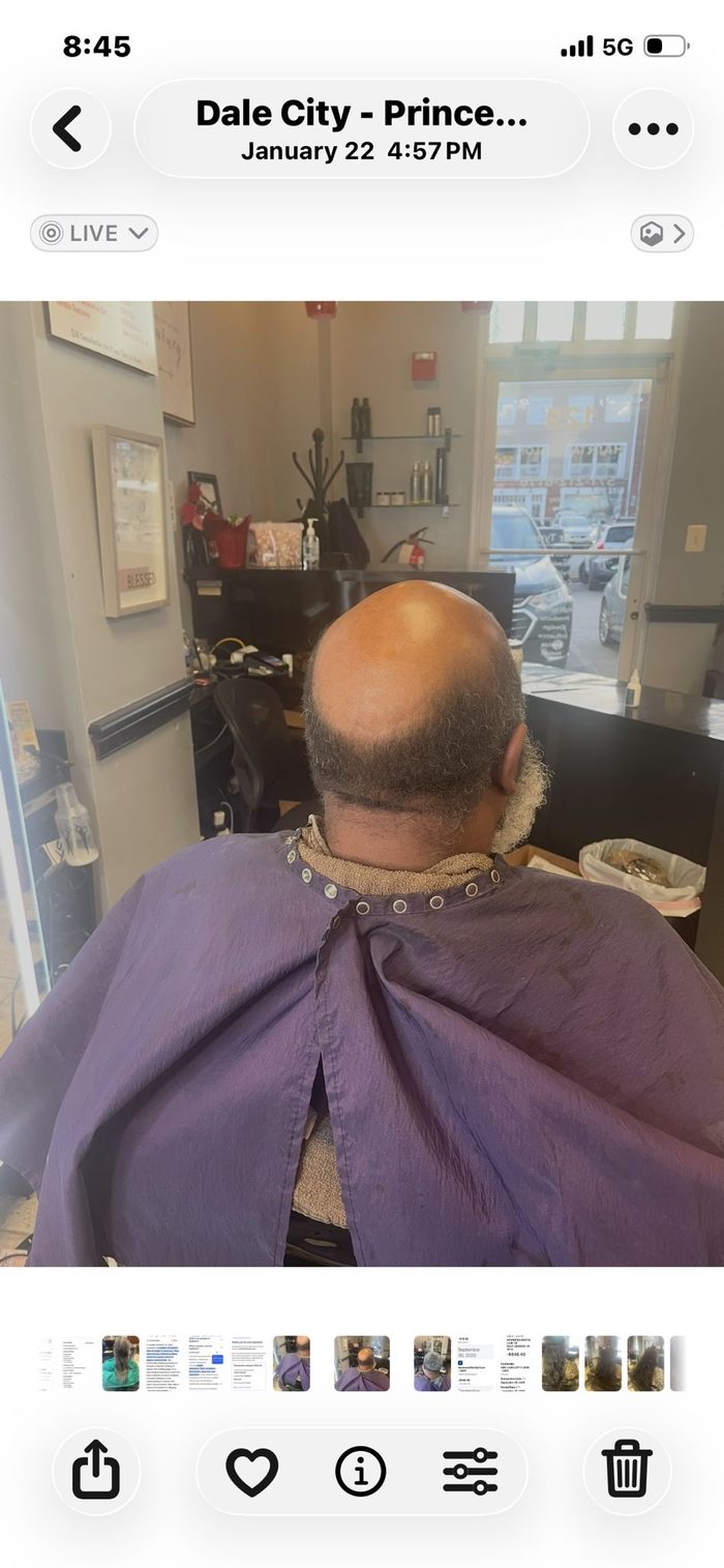Client 3 before hair restoration