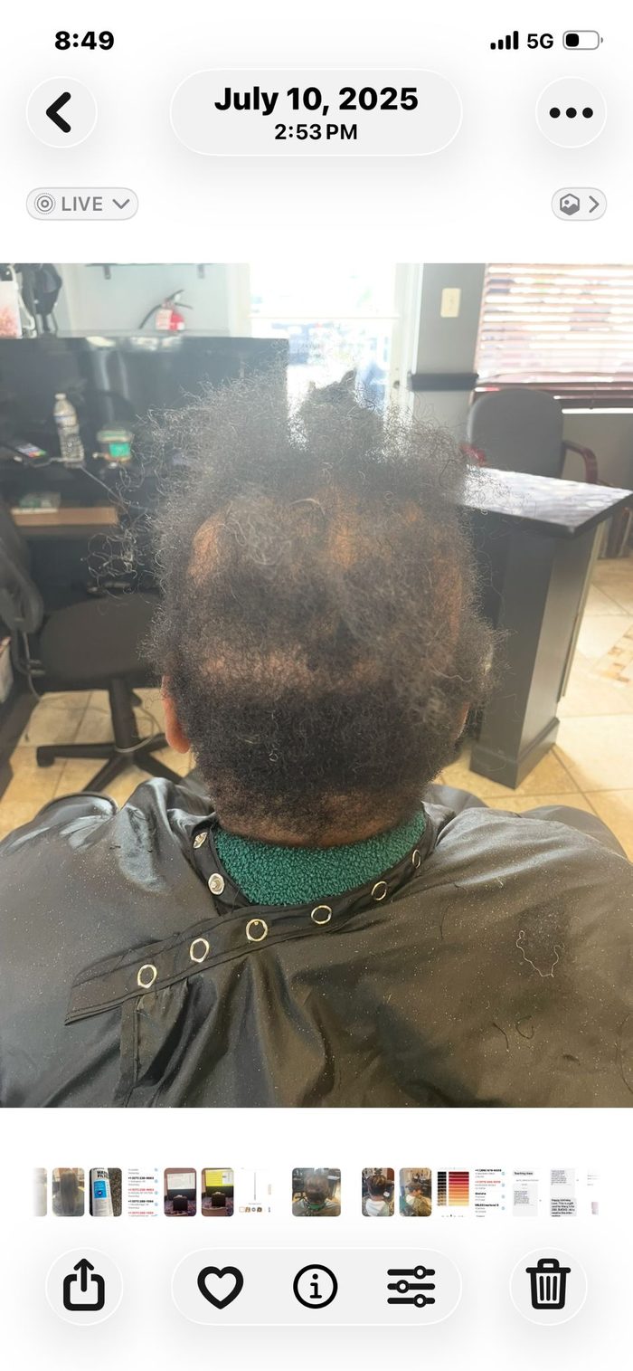 Client 4 before hair restoration